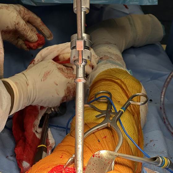 Caso real de artroplastia de cadera 11