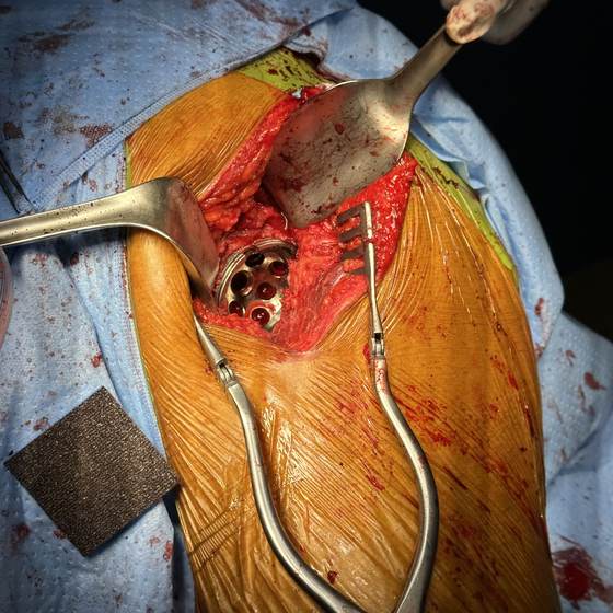 Caso real de artroplastia de cadera 19