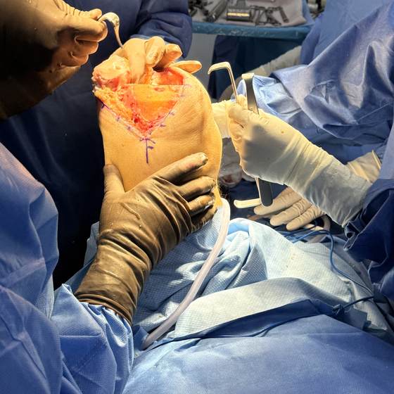 Caso real de artroplastia de rodilla 03