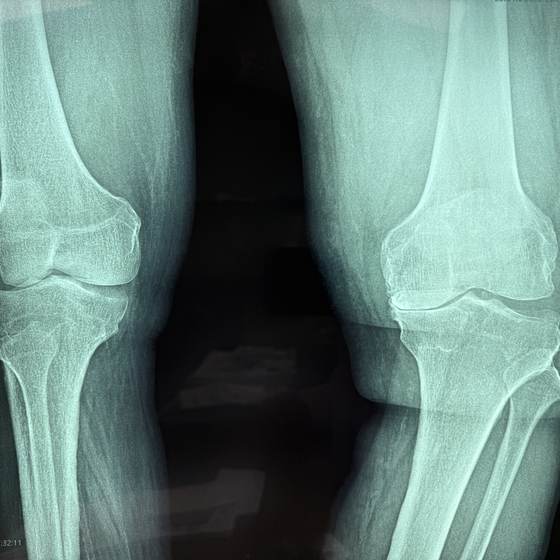 Caso real de artroplastia de rodilla 06