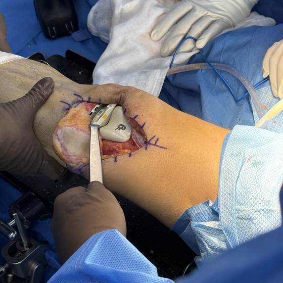 Caso real de artroplastia de rodilla 14