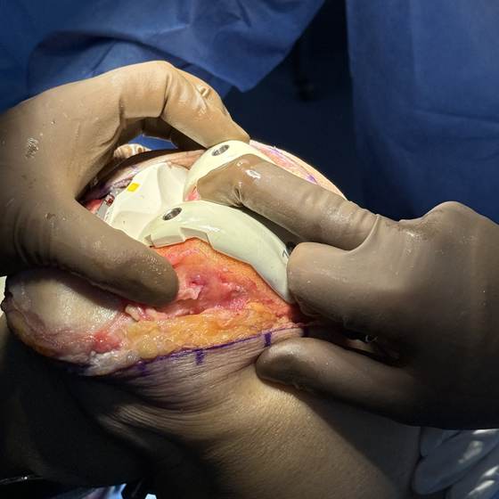 Caso real de artroplastia de rodilla 15