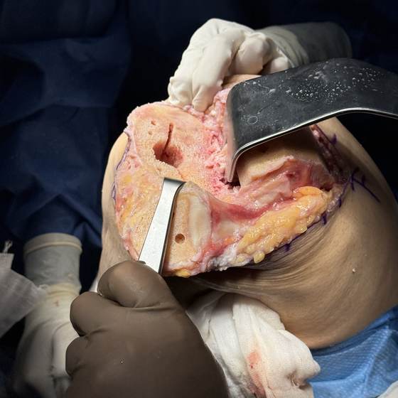 Caso real de artroplastia de rodilla 20