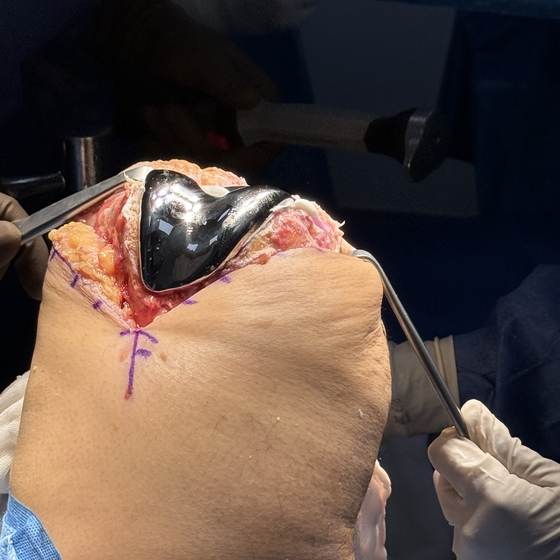 Caso real de artroplastia de rodilla 24