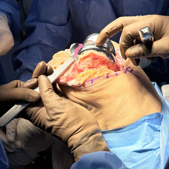Caso real de artroplastia de rodilla 25