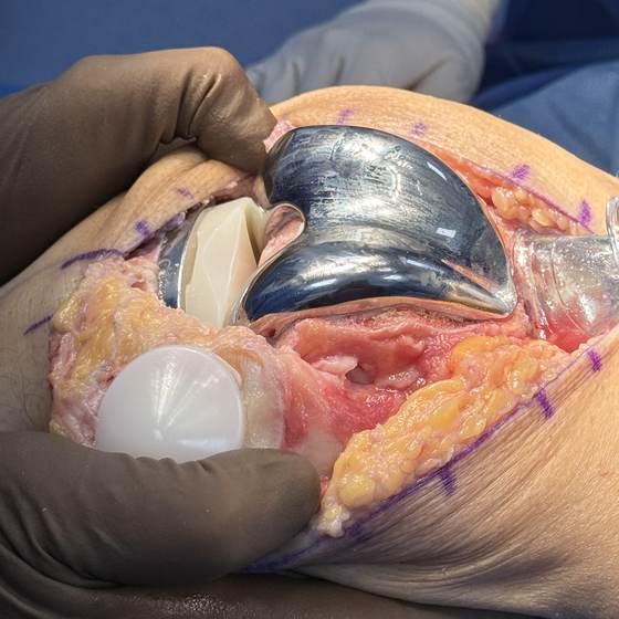 Caso real de artroplastia de rodilla 28